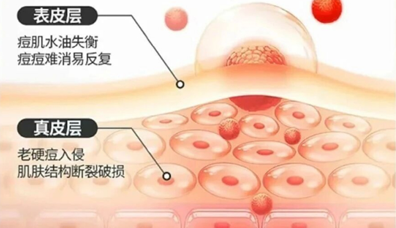 专研净痘修护！高渗透纤连蛋白TFNpro获专业检测验证，助力平抚痘肌困扰